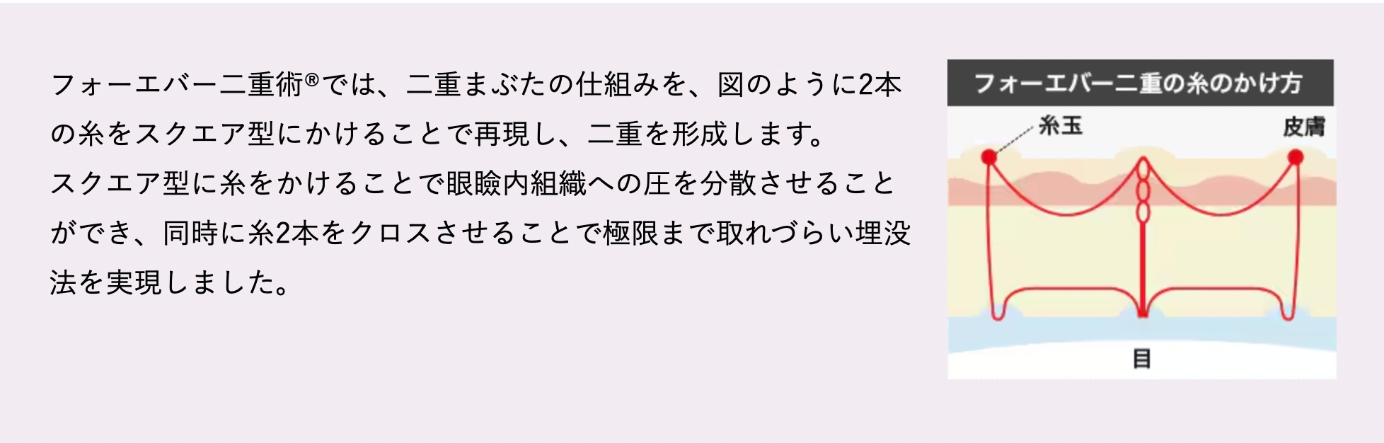 どんな埋没法？