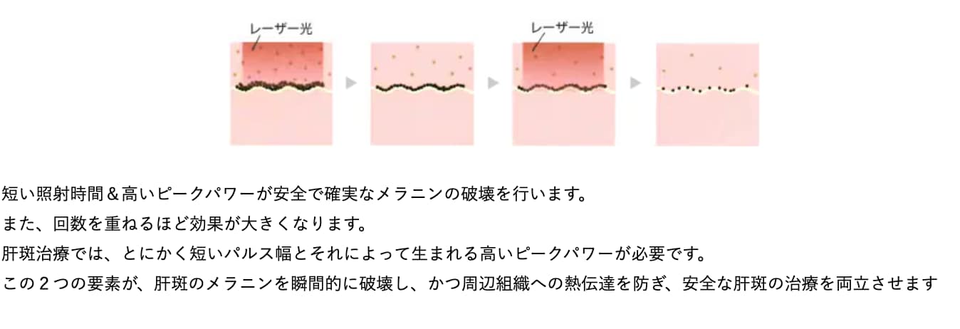 肝斑でもできる『レーザートーニング』