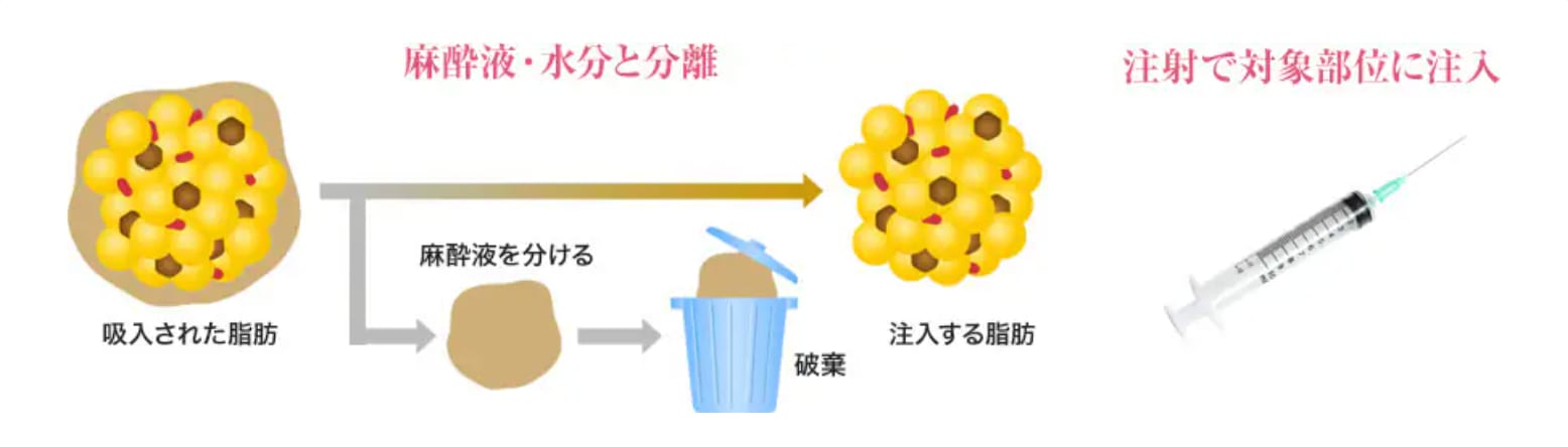 ナチュラル脂肪注射ってどんな施術？<br />
