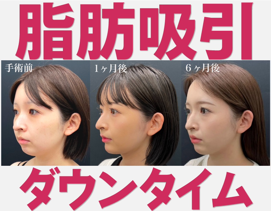 【医師監修】《顔の脂肪吸引 ダウンタイム長期経過》実際のダウンタイム経過とダウンタイムを軽減するコツを湘南美容クリニック赤羽院院長の佐藤医師が徹底解説！