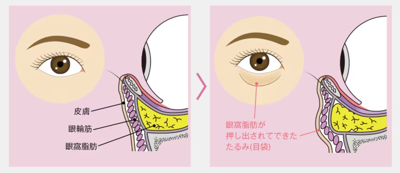 みんなが悩む《目の下のクマ》の原因って？