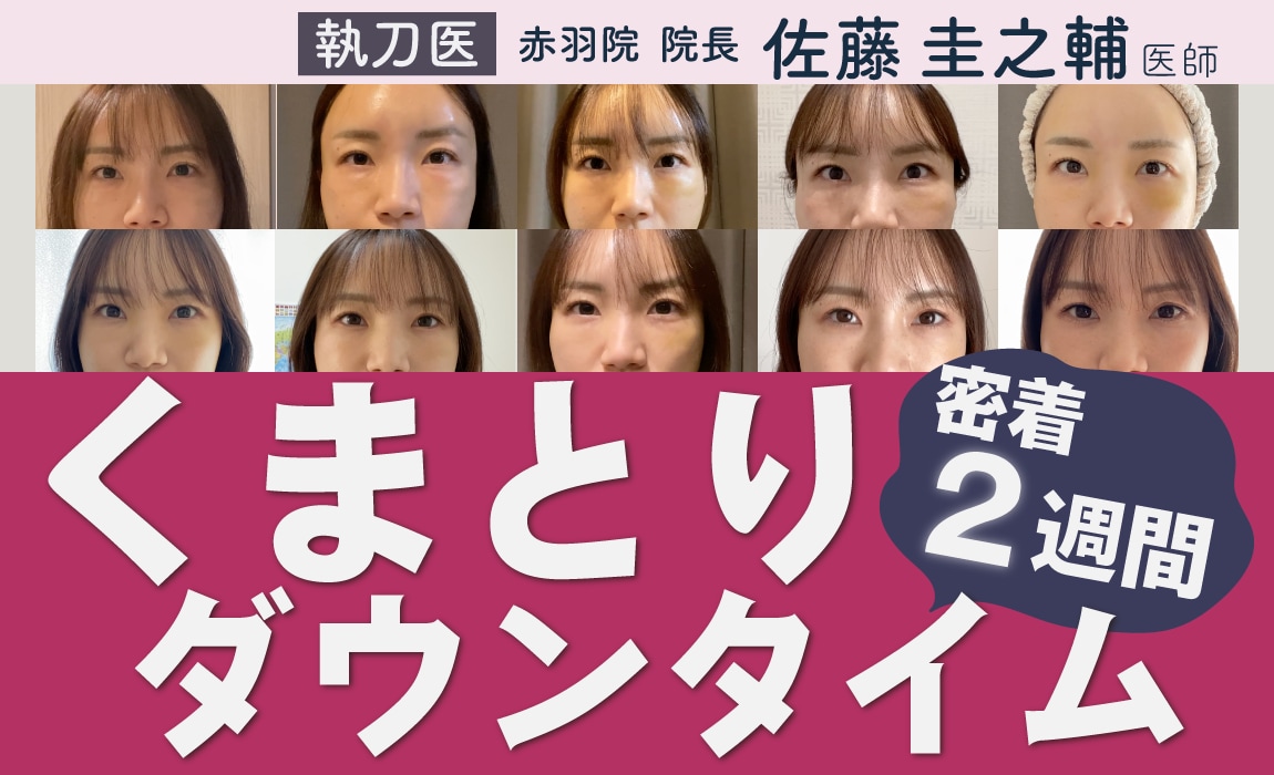 《目元のクマに悩む方必見👀》ダウンタイムが不安、、、そんな方は見て！《リアルレポート》目の下のクマ取り２週間のダウンタイム経過【東京：クマ取りの名医！赤羽院院長佐藤圭之輔によるクマ取り術】