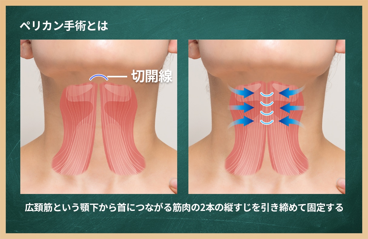 筋肉のたるみを処理