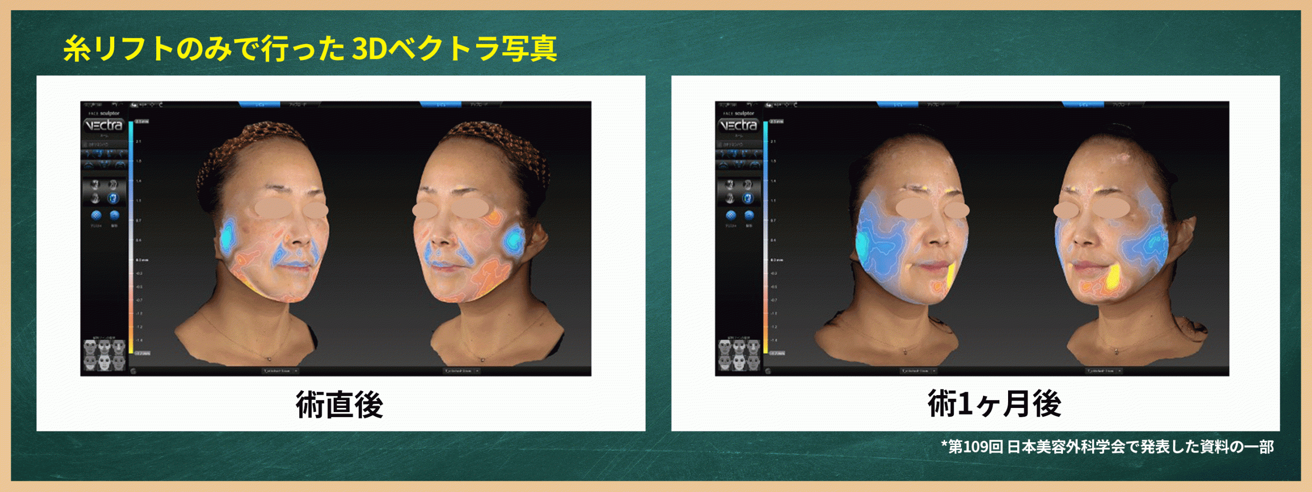 3Dカメラで撮影した結果