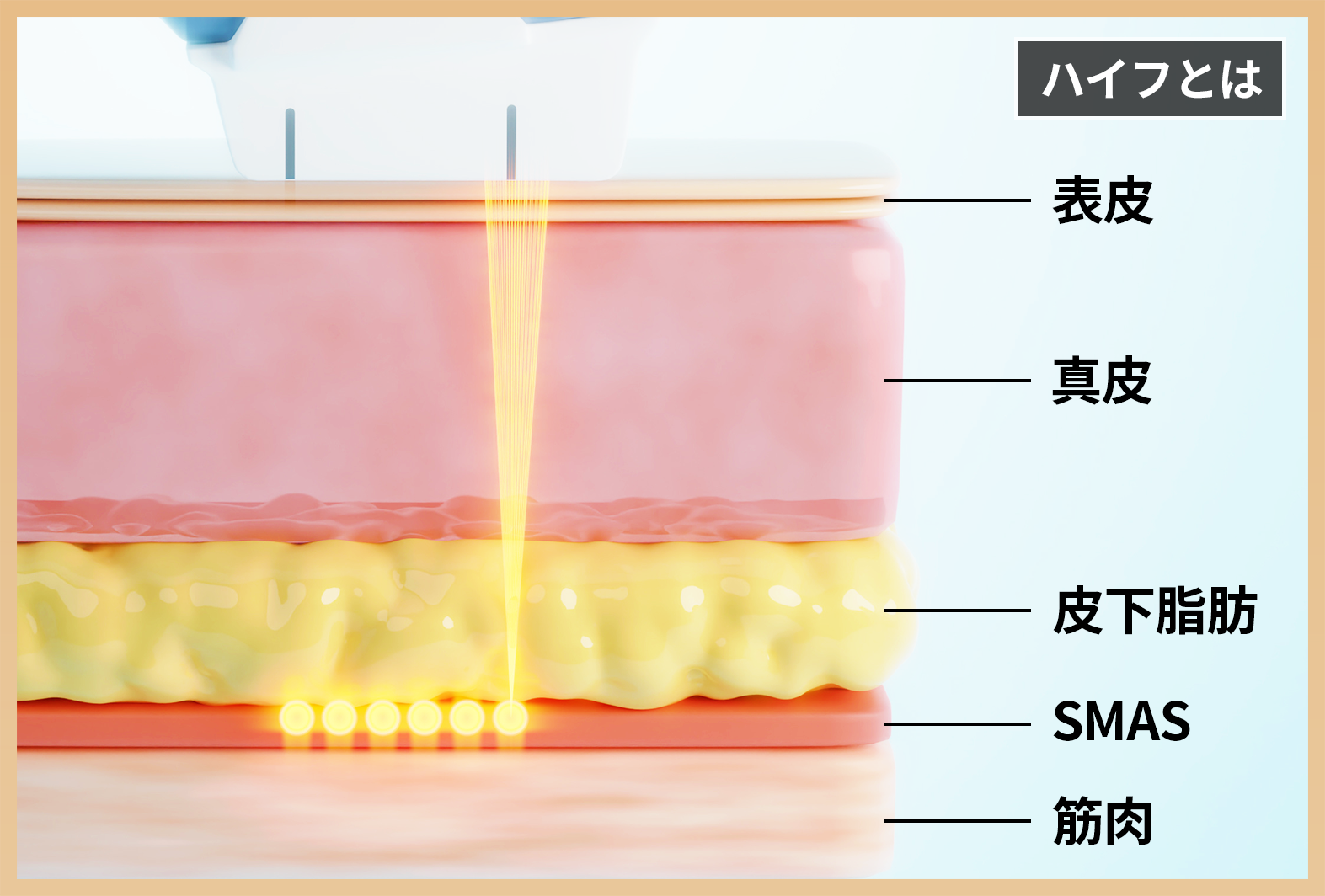 ハイフ＝焦点式超音波治療