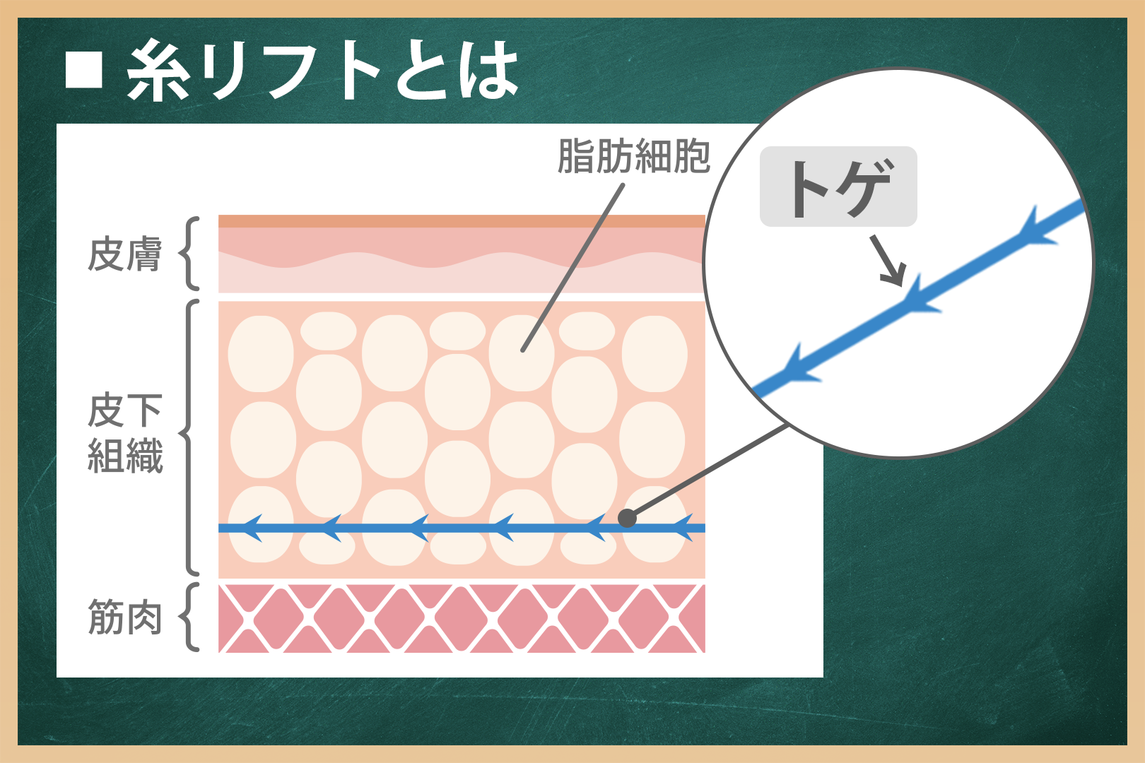 糸リフトは○○できる