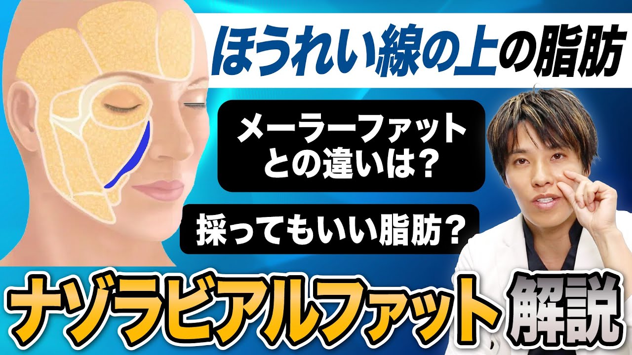 【顔の脂肪吸引】ほうれい線の上の脂肪ナゾラビアルファットとは？メーラーファットとの違い・リスクを解説！