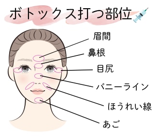 シワの改善方法