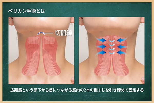 筋肉のたるみを処理