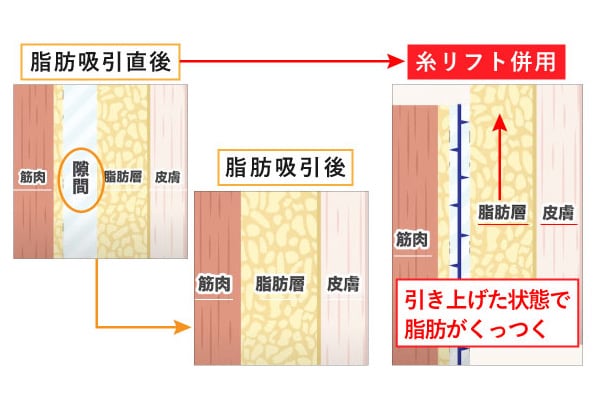 脂肪吸引×糸リフト＝サクションリフト