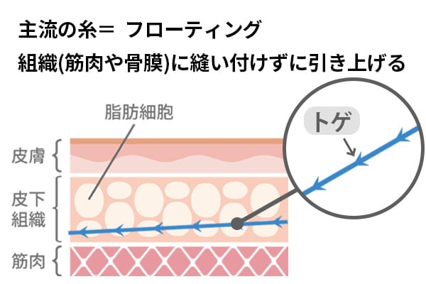 糸リフトを知ろう