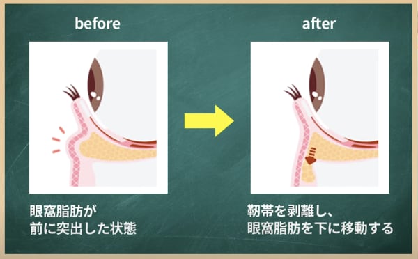 有効な治療 “裏ハムラ法”