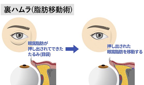 目の下に膨らみとへこみがある場合