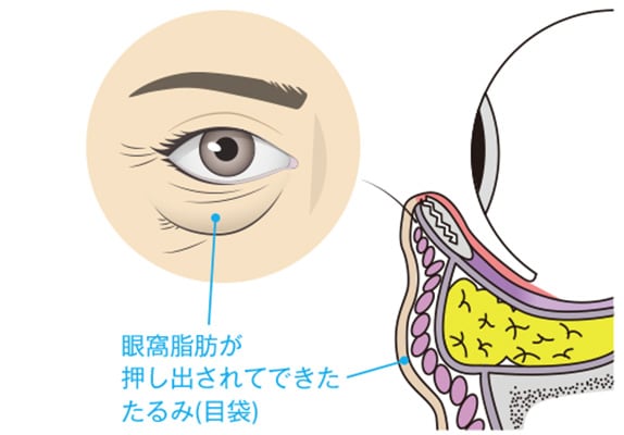 シワ取りの限界