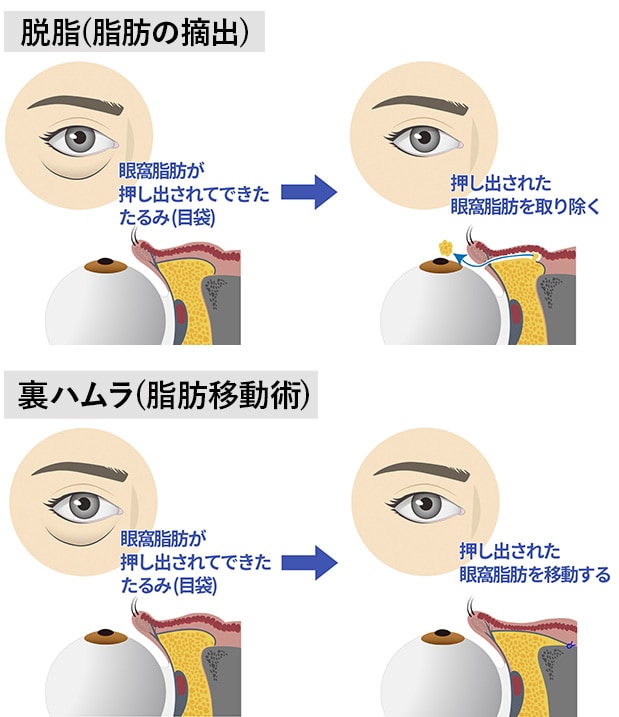 目の下に膨らみとへこみがある場合