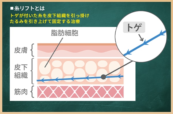 糸リフトとは