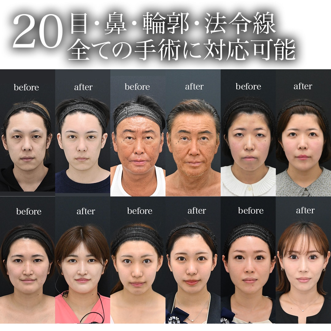 20.Dr. Nagura is capable of performing surgeries for the eyes, nose, facial contours, and nasolabial folds.<br />
