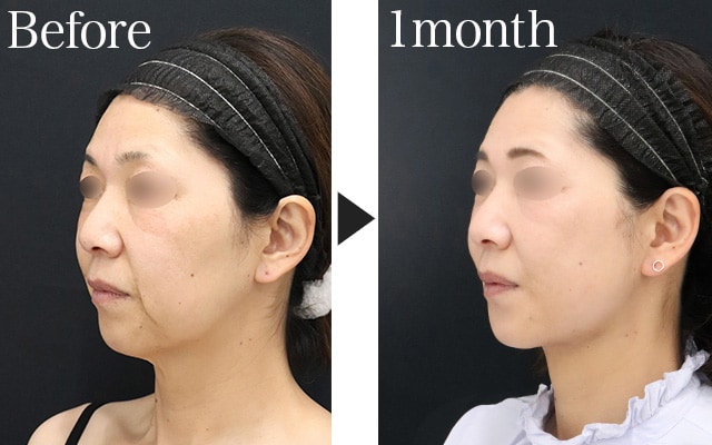 3. Sagging: Sharpen Your Facial Contours