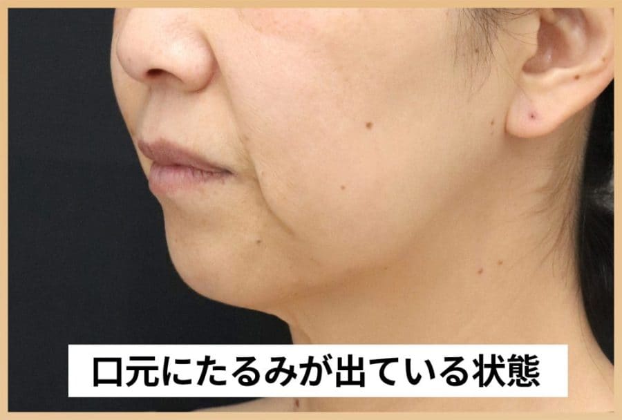 たるみを引き起こす2大要因「重力」と「脂肪」