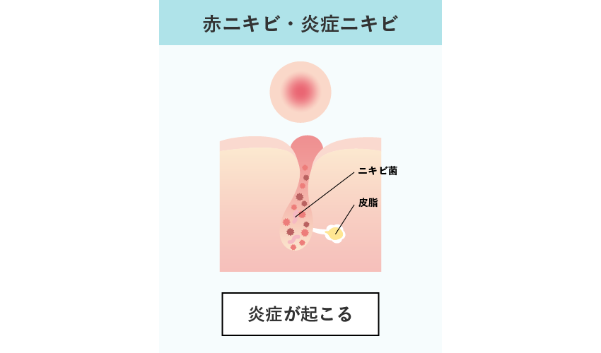 赤ニキビ・炎症ニキビ