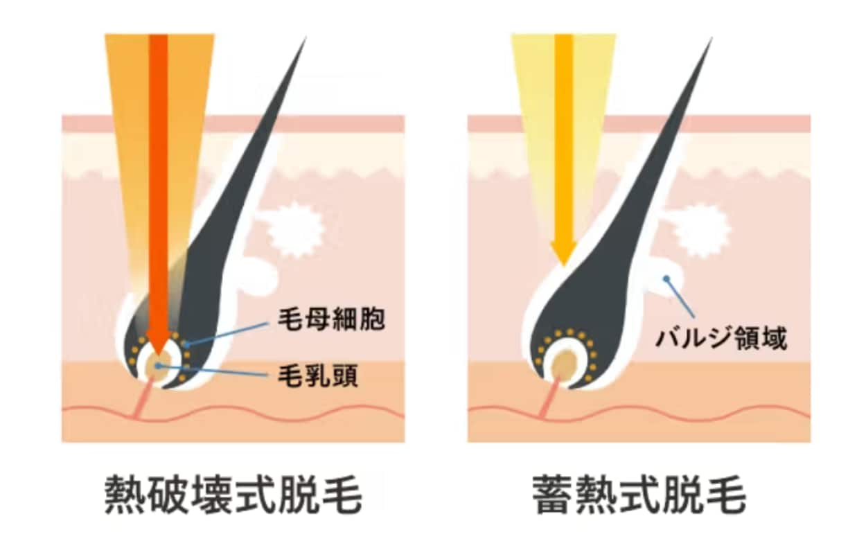 大人気の最新脱毛器を完備