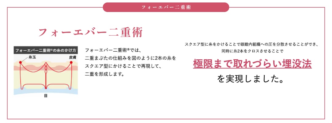 フォーエバー二重術とは？