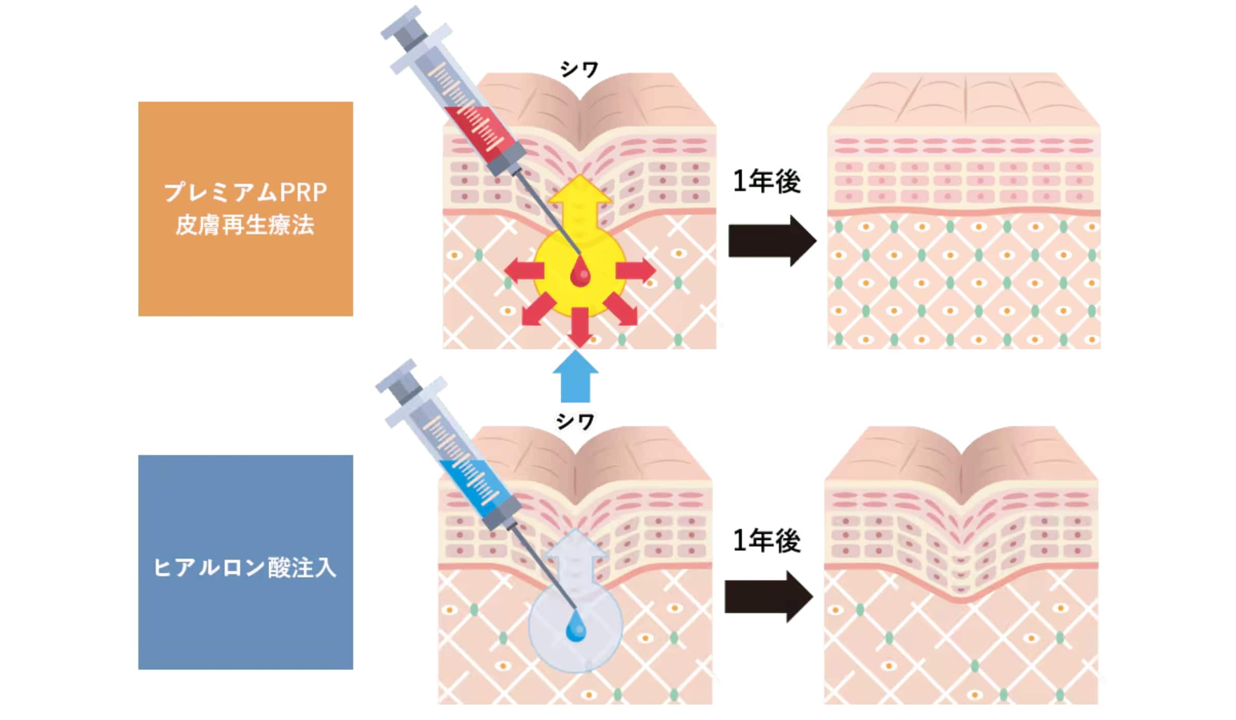 効果が出るまでの期間や持続性が異なります