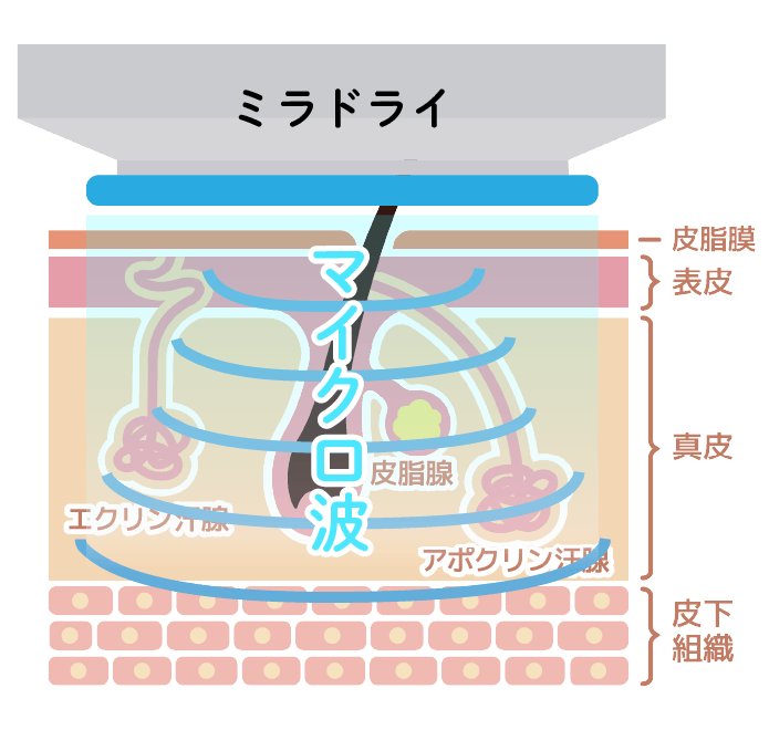 ミラドライの仕組み