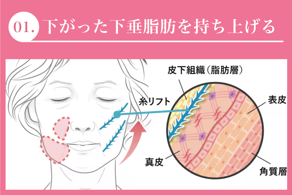 糸リフトの効果1