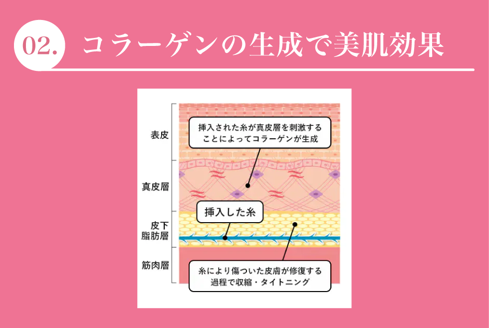 糸リフトの効果2