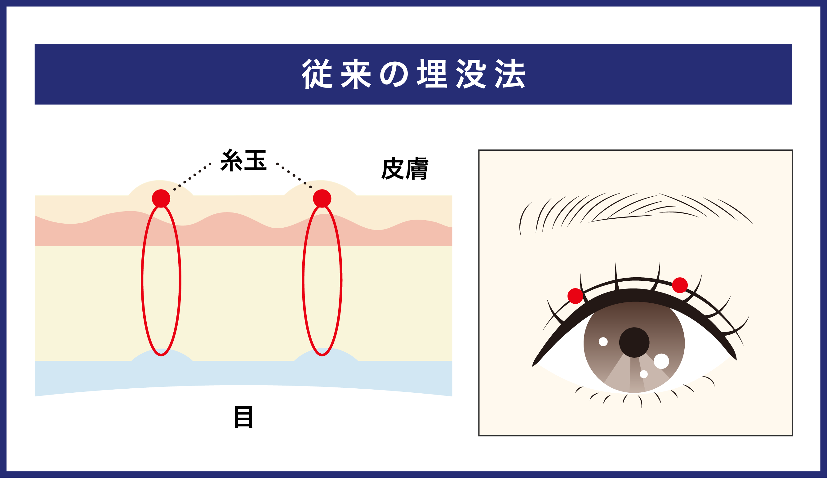 従来の埋没法