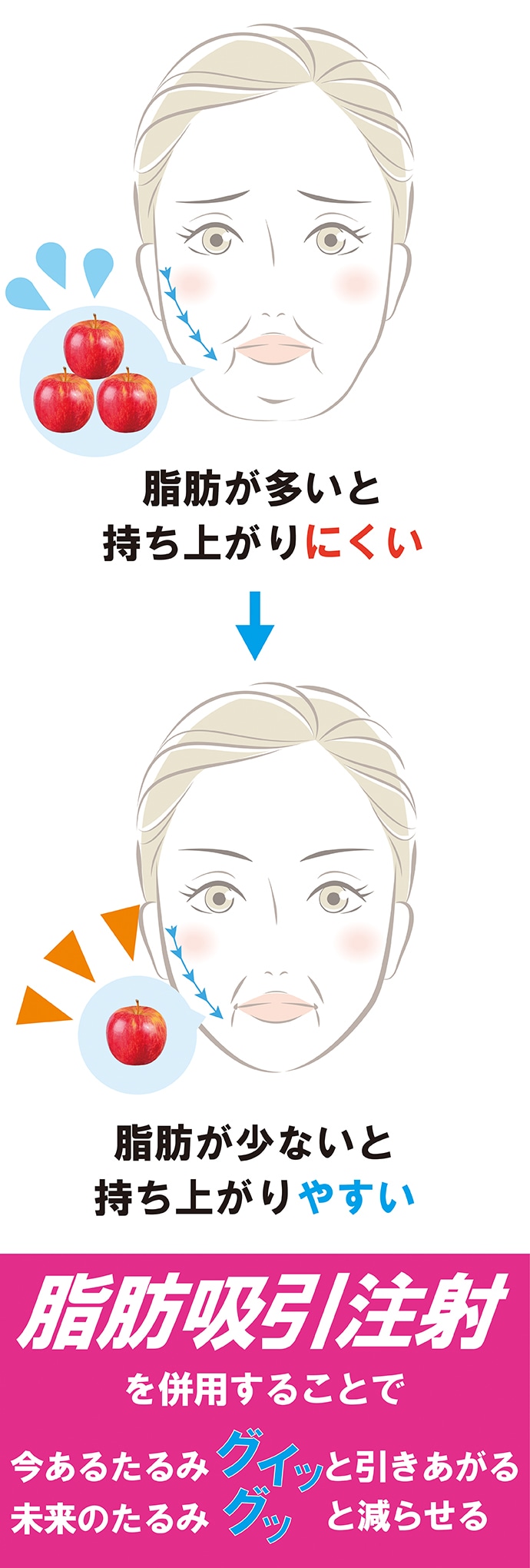 糸リフト×脂肪吸引注射は一石三鳥♪