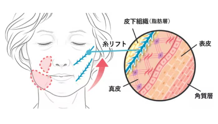 糸リフトとは？