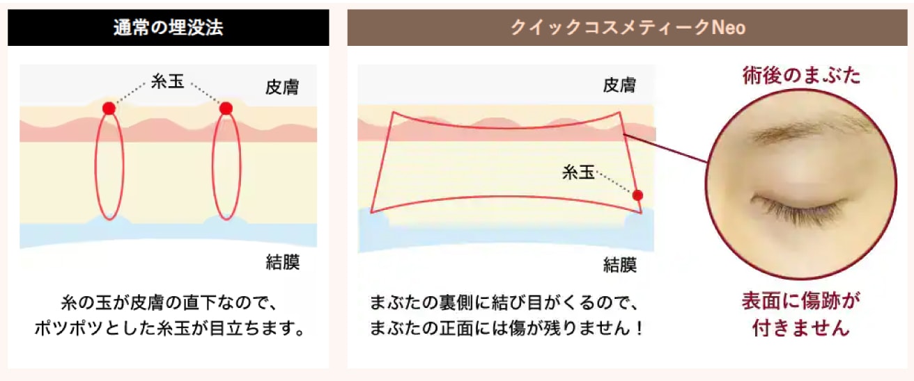 限られた医師のみ執刀可能な二重埋没法【クイックコスメティーク】ができる！