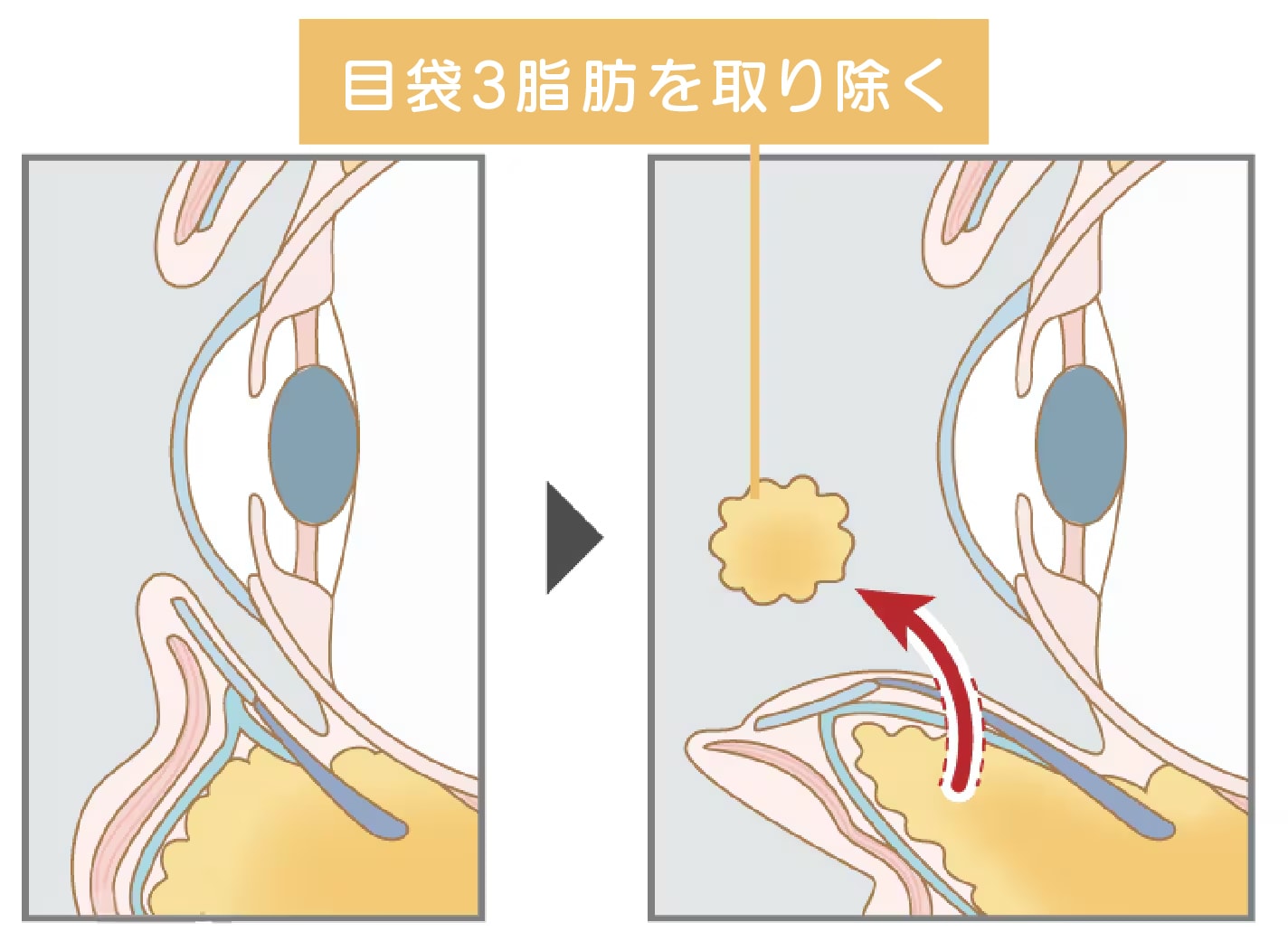 目の下の切らないクマ・たるみ取り【膨らみ改善】