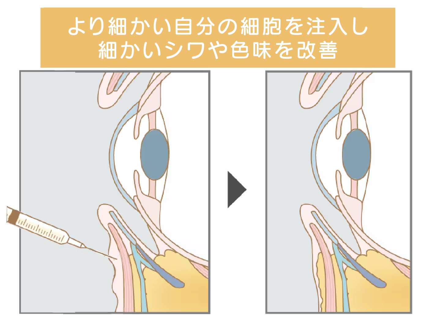 脂肪注入：ナノリッチ【小ジワ・色味改善】