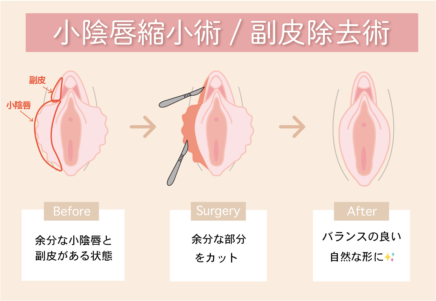 小陰唇縮小術/副皮除去術