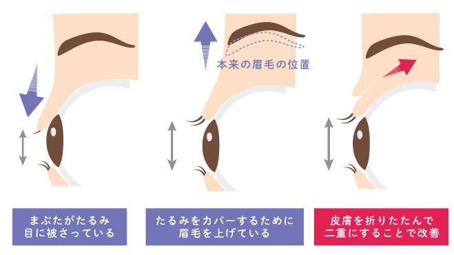 切らないまぶたのリフトアップの仕組み