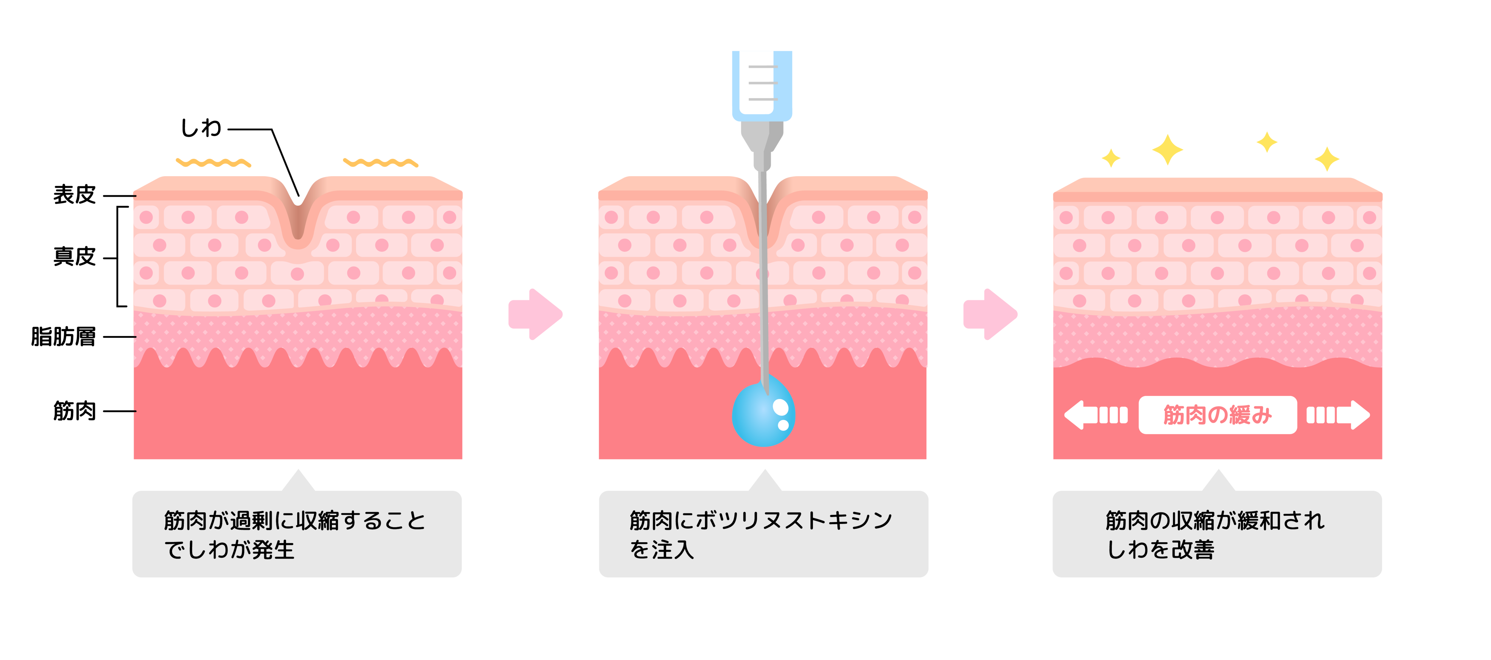 ボトックス注射って？