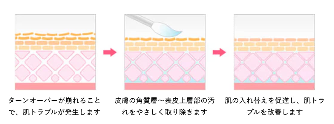 医療用の薬剤の力を利用し、皮膚に働きかけることで、ターンオーバーを促して古い角質や老廃物を除去する施術