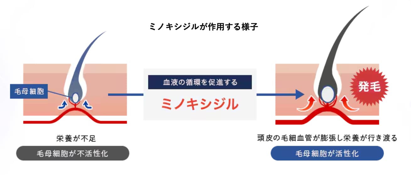 【AGAブロックと血行促進効果】クイックメソ スタンダード（ミノキシジル）