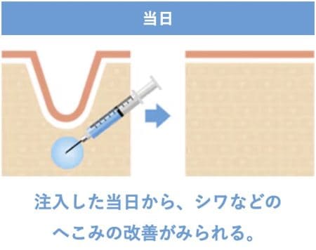 クマ取り×ヒアルロン酸注入