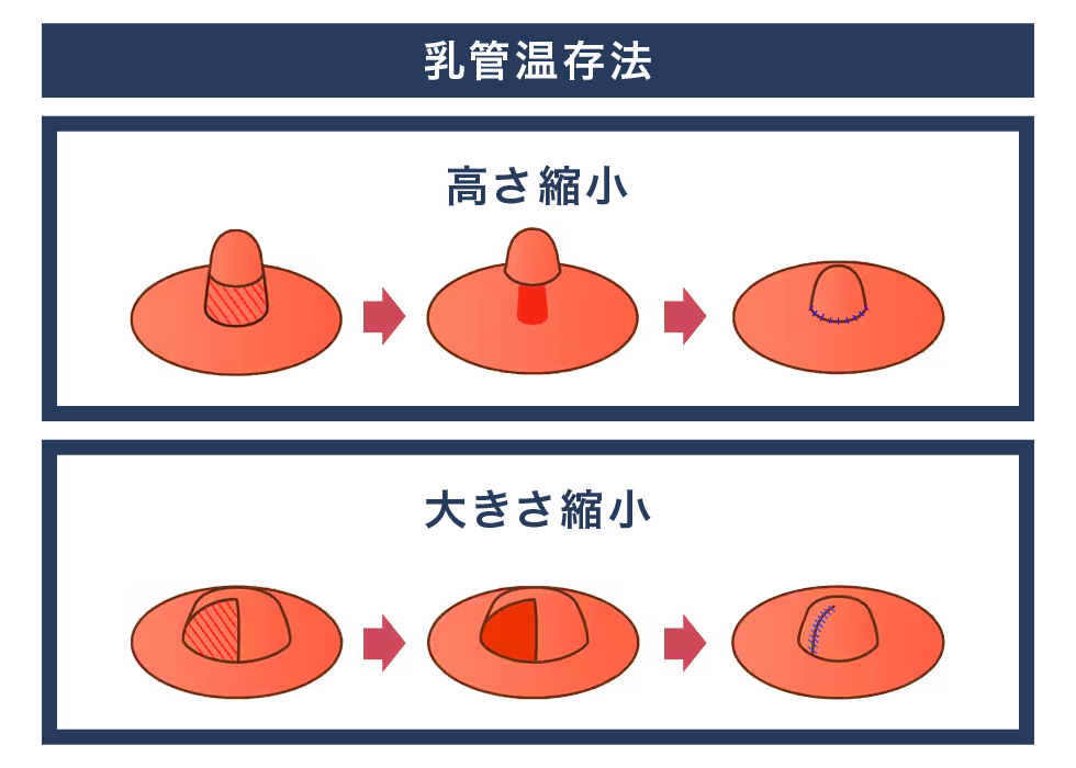 乳頭縮小術で解決！