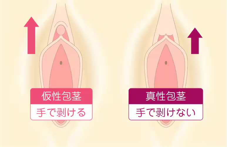 陰核包茎をセルフチェック！