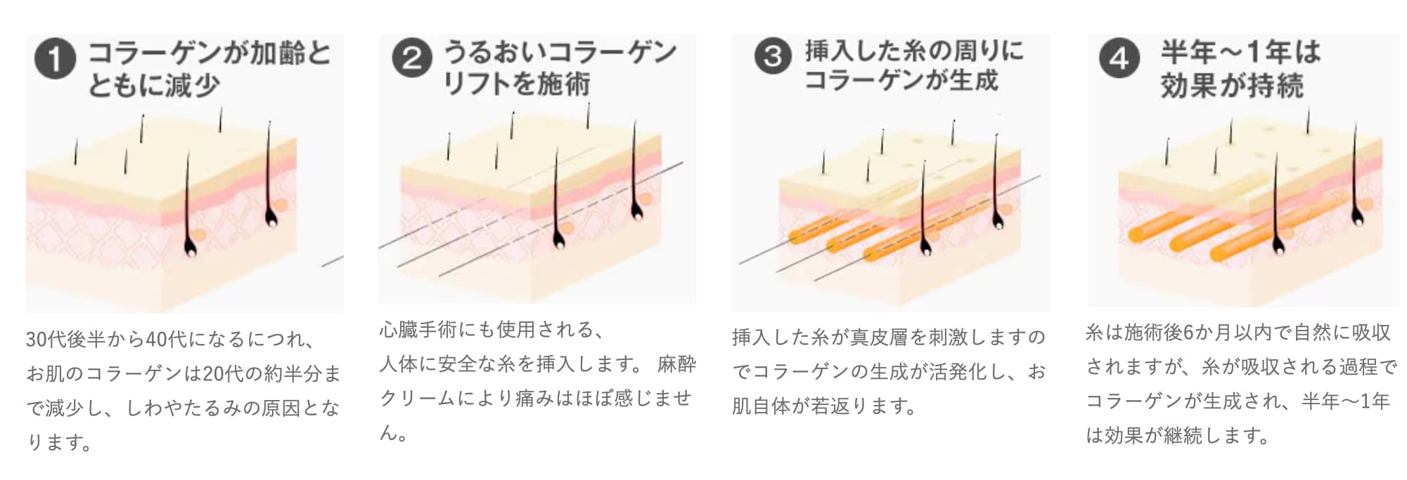 うるおいコラーゲンリフトとは？