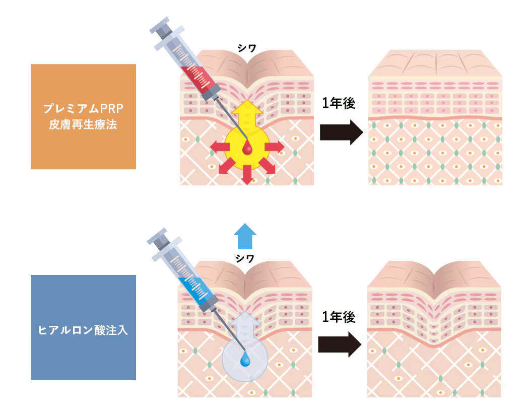 PRP 再生医療 脂肪注入 コンデンスリッチ ナノリッチ ヒアルロン酸 頬コケ 銀座 東京 岩砂里美