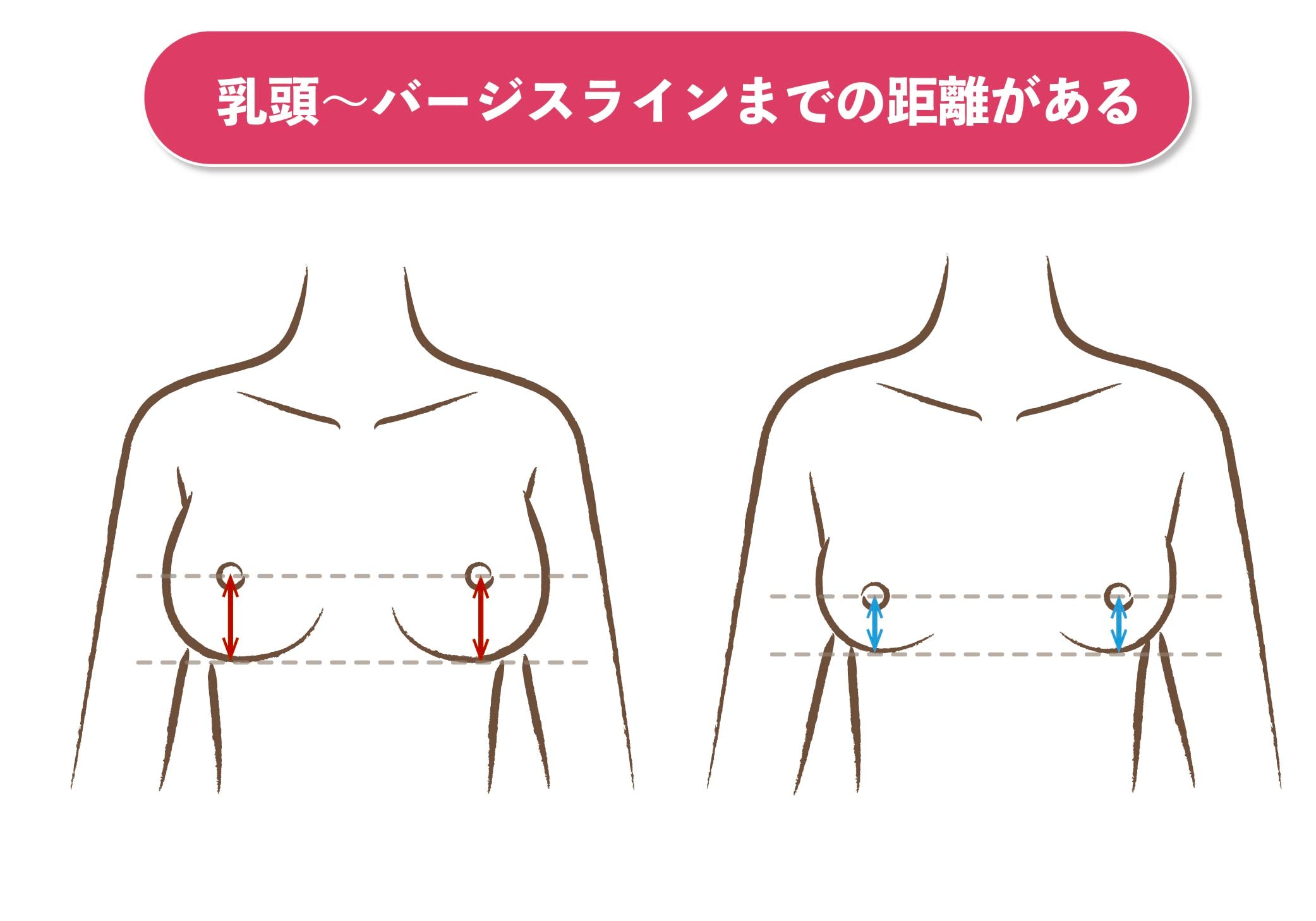 ⑤乳頭からバージスラインまでの距離がある