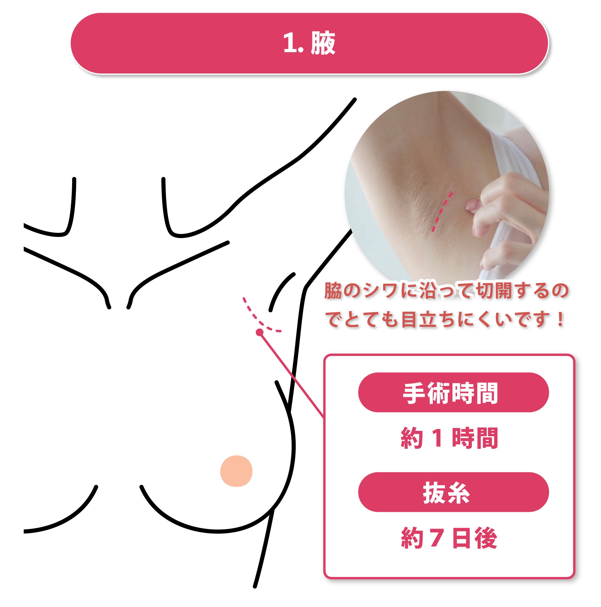 腋のシワに沿った部分