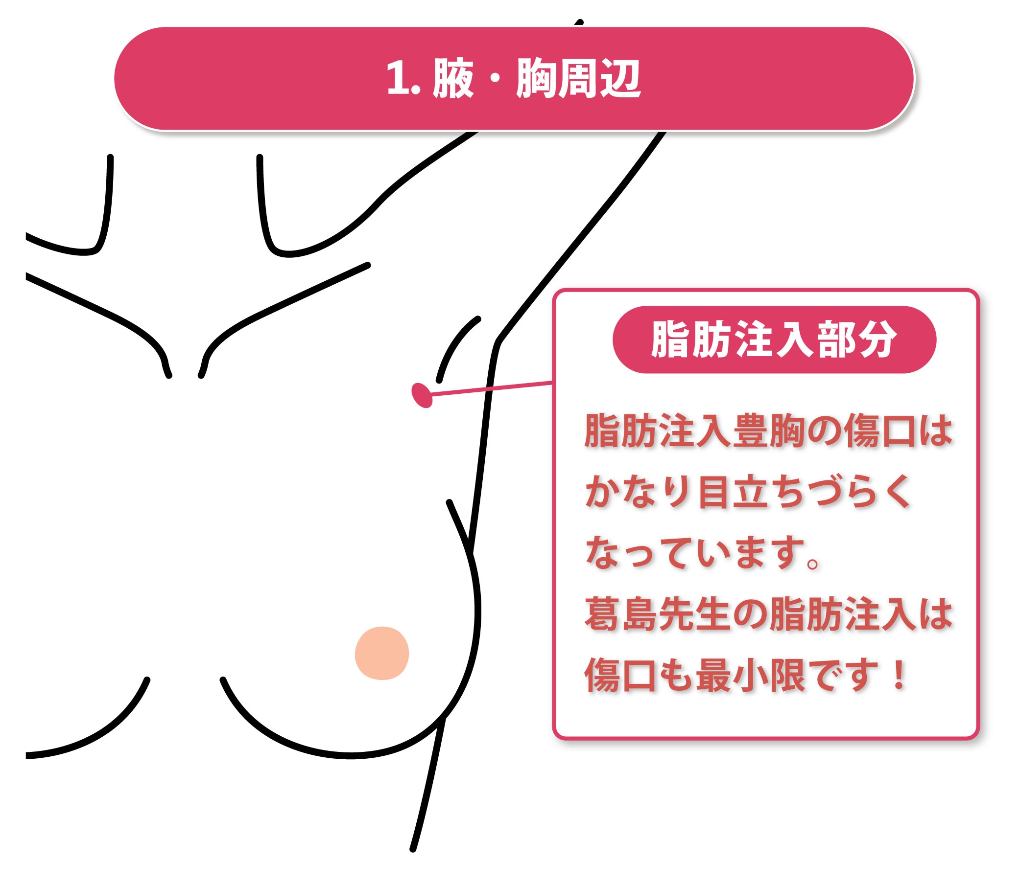 腋のシワ部分と胸の周辺