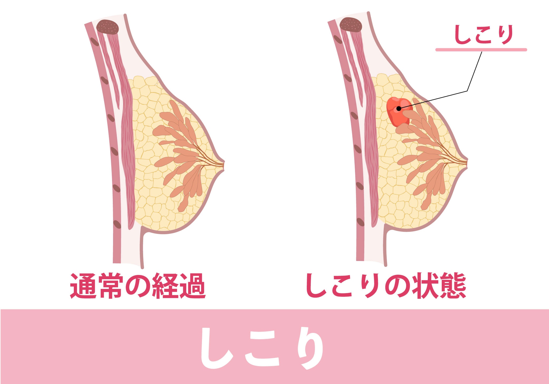 しこりとは？